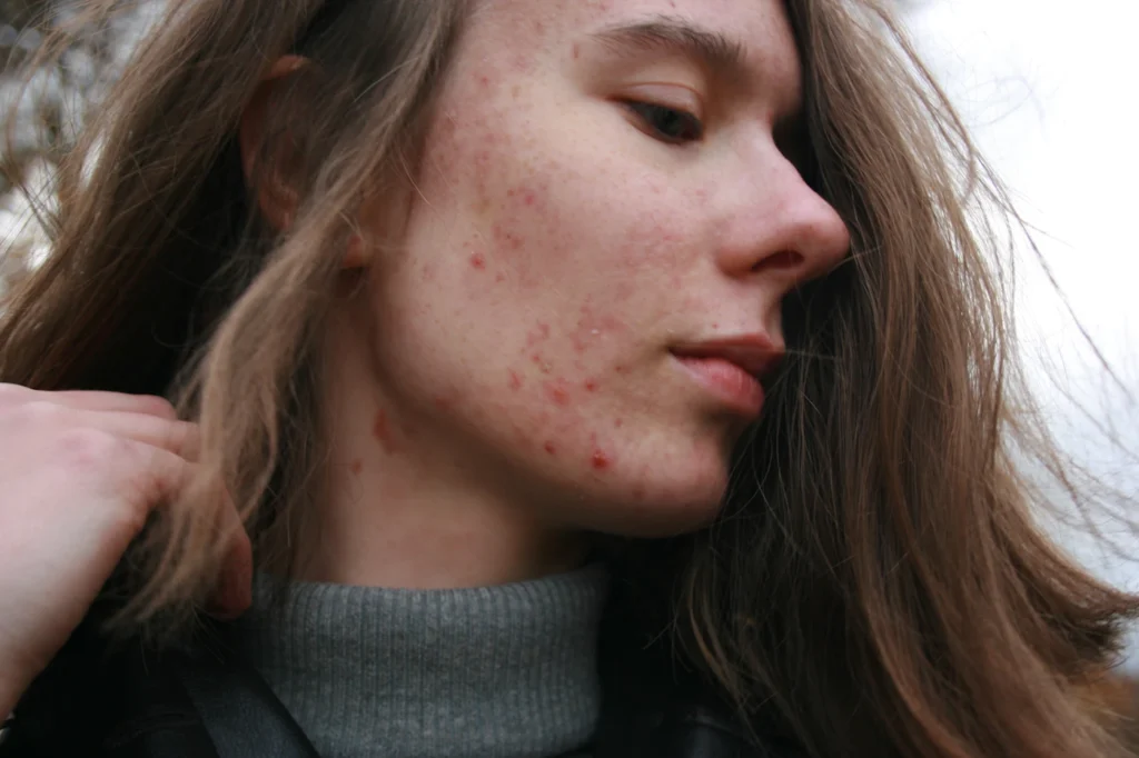 Tretinoin vs adapalene acne treatment and topical retinoid skincare